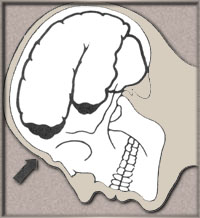 Contusion from forces which cause brain injury