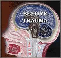 Head Before Trauma: Before Impact Brain Damage