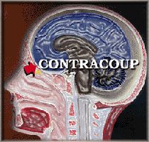 Contracoup: Impact brain damage