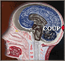 Coup: Impact brain damage