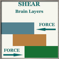 Shear Diagram - Diffuse axonal injury