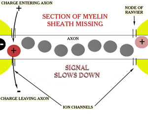 Mising Myelin Sheath - Evolving brain damage